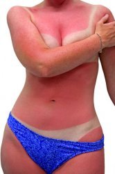 Американские ученые выяснили, из-за чего на коже возникает солнечный ожог